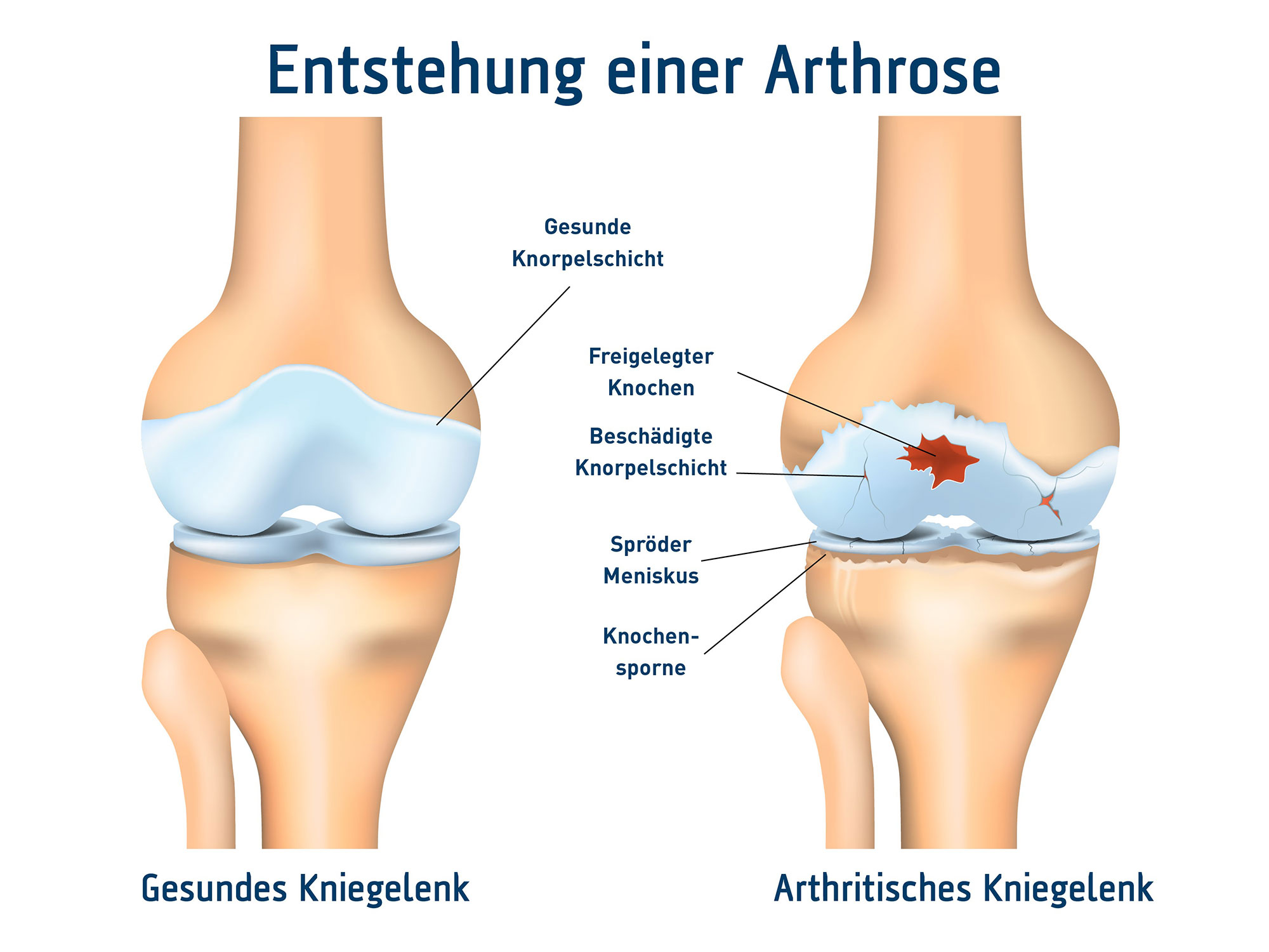 Volksleiden_Entstehung einer Arthrose Zertifizierungen der Mitschke Sanitätshäuser